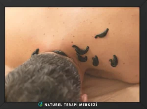Boyun bölgesine uygulanan tıbbi sülük tedavisi (Hirudoterapi) - Ağrı ve dolaşım bozukluğu için doğal yöntem | Naturel Terapi Merkezi