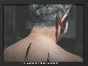 Boyun ve omuz bölgesine uygulanan tıbbi sülük tedavisi (Hirudoterapi) - Naturel Terapi Merkezi İstanbul