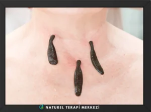 Tıbbi sülük boyun bölgesi uygulaması - Hirudoterapi tedavisi | Naturel Terapi Merkezi